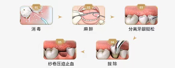 智齿,拔牙,牙周炎,根管治疗
