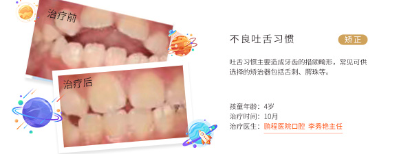 不良吐舌习惯
